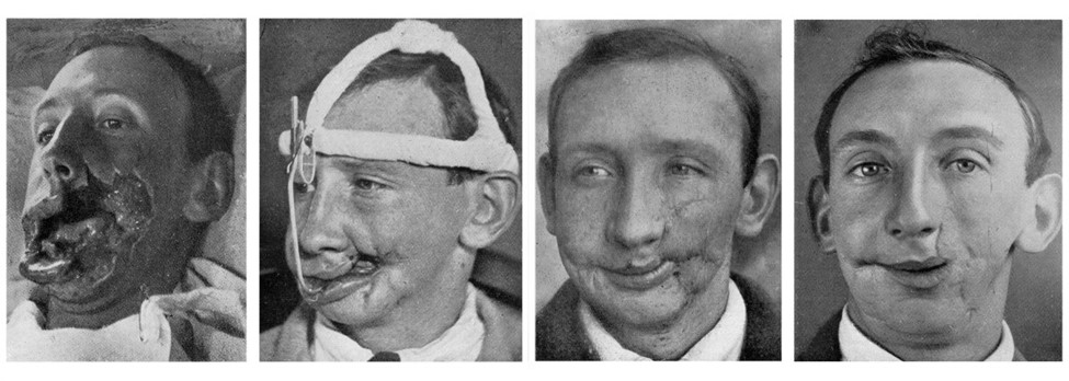 Reconstrucția facială a unui soldat al cărui obraz a fost grav rănit în timpul bătăliei de pe Somme din iulie 1916